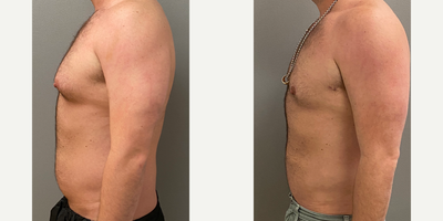 35-44 year old man treated with Liposuction, SAFELipo, Tumescent Liposuction - 39 yo s/p abdominal liposuction performed under sedation in our on site AAAA certified operating suite