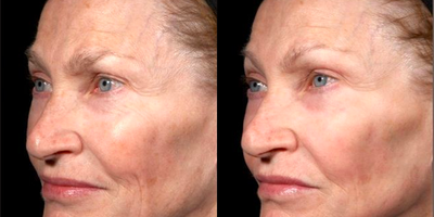 Woman treated with Pearl Laser - Pearl Laser