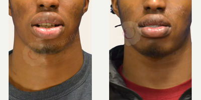 Man treated with Lip Reduction - Man treated with Lip Reduction
