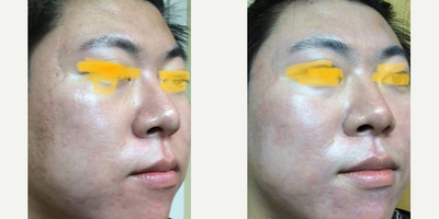 Man treated with Fraxel Laser - Man treated with Fraxel Laser