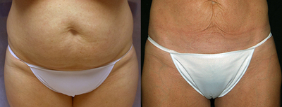 35-44 year old female treated with Aqualipo on abdomen and bra bulge - This 40-year old patient&nbsp;had Aqualipo liposuction to her stomach and to eliminate her bra bulge. We personalize each liposuction to the patient's individual needs and typically use a combination of Body Jet water liposuction and SmartLipo laser liposuction to achieve optimal fat removal and skin tightening. Most patients are able to return to work within 2 days or less.