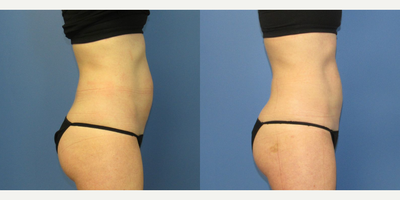 35-44 year old woman treated with CoolTone - 35-44 year old woman treated with CoolTone