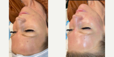 Woman treated with Dermaplaning - DiamondGlow & Dermaplane for exfoliation & hydration!