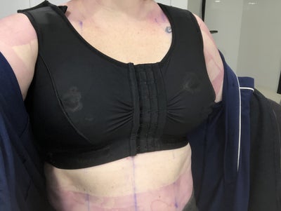 Doctor told patient not to have reduction surgery on 34HH breasts