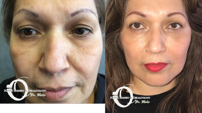 40-50 year old woman with Neck lift and transconjunctival blepharoplasty (eye surgery)  - Neck lift and transconjunctival blepharoplasty (eye surgery)