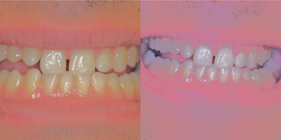 35-44 year old man treated with Zoom Whitening - Patient discussed his desire for a brighter smile during his recall cleaning and exam appointment. patient decided to give the Zoom! in office whitening a try immediately following his cleaning.