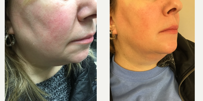 35-44 year old woman treated with Vein Treatment - VeinGogh (Ohmic Thermolysis) a microburst technology in the treatment of facial spider veins. Before and After Pictures.