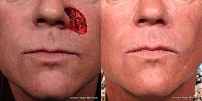 Mohs Surgery - Mohs Surgery