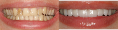 Porcelain Veneers - 
	Smile Makeover case using 8 porcelain veneers.

	Removed all old bonding. &nbsp;
