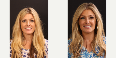 35-44 year old woman treated with Porcelain Veneers, Dental Implants, Dental Bridge - This patient's smile was transformed with the help of Dr. Frazar, our cosmetic dentist, and Dr. Friedberg, out periodontist.  We perform everything under one roof.