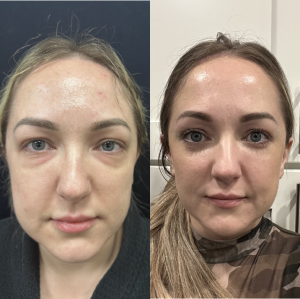 40 year old woman treated with Eyelid Surgery - 40 year old woman treated with Eyelid Surgery