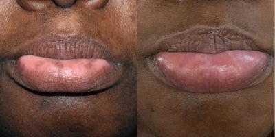 Los Angeles lip spot removal with lasers.  Before and after photos. - Another lip spot success!  Smoker's and those genetically predisposed to developing lip spots have been reveling in the success of our Palomar Qyag V q-switched lasers to remove sun damage and other pigment on the lips.  Call today for more info.