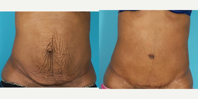 35-44 year old woman treated with Painless/Drainless Tummy Tuck - Dr. Feng performed tumescent liposuction of the hips and back to improve the contour of the trunk. She then performed intercostal blocks prior to starting the abdominoplasty and repairing the large tear in the diastasis recti. She anchored the subcutaneous tissue down to the muscle layer using progressive tension sutures to achieve a better definition of the abdomen and to avoid the use of drains. The after photos are 5 months post-op.