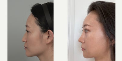35-44 year old woman treated with Cheekbone Reduction, Double Eyelid Surgery, Eyelid Surgery, Facial Fat Transfer, Mini Facelift - .