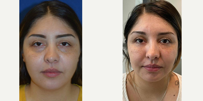 25-34 year old woman treated with Facial Fat Transfer - Patient received neck liposuction and fat transfer to under eyes
