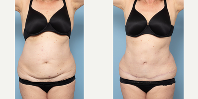 55-64 year old woman treated with Tummy Tuck, Diastasis Recti Repair - 64 year old3 children8 months post opAbdominoplasty with repair of rectus diastasis