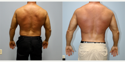 45-54 year old man treated with Abdominal Etching, Vaser Liposuction, Skin Tightening - This patient had Skin Tightening with Vaser Abdominal Etching.