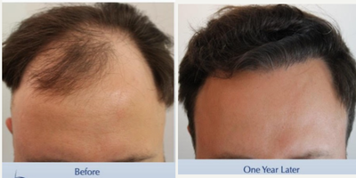 Small Punch. Big Results (2717 FUE grafts) - This 34-year-old man underwent a follicular unit extraction (FUE) session with Dr. Carlos K. Wesley in which a total of 2717 grafts were placed.  Aspects of our surgical approach can be viewed on our sites Most Common Questions page. Three elements combined to help improve his experience: graft harvest, graft storage, and patient safety. Rather than a larger FUE punch used by a robotic approach, Dr. Wesley used a smaller caliber hand-held motorized punch to performed the donor harvest.  This approach better enabled the capture of donor intact hair roots that are slightly curved beneath the skin surface.  Upon completion of the harvest, the patients donor area was treated with PRP and A Cell in order to not only minimize scar tissue formation, but also encourage partial regeneration of donor hair follicles.Graft storage was optimized as hair follicles were incubated in autologous (his own) platelet rich plasma (PRP) throughout the duration of the procedure.  This, combined with an ATP-containing storage solution has been shown to enhance survival of transplanted hairs.Finally, having his procedure performed in our office with the highest standards of COVID precautions helped ensure patient safety. Every patient of Dr. Wesleys receives a rapid COVID test upon arrival to our office equipped with an ultraviolet air purification system. Measures such as reducing foot traffic by performing virtual consultations at no charge to patients, regular staff COVID testing and no-touch temperature checks of our team that avoids public transportation help preserve our clean and sanitary safe haven. Daily sterilization of the office coupled with the most rigid OR safety precautions further allay patient concerns in this sensitive time.  The patient returned one year after his procedure and images of the patient can be seen below. This link illustrates the timing of hair growth after surgery. Similar patient hair transformations with Dr. Wesley and his team may also be viewed.
