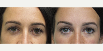 34 year old woman treated with Dysport - This patient was concerned with aging in the eye area.