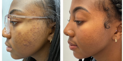 18-24 year old woman treated with Spironolactone For Acne - Topical treatment with clindamycin and tretinoin for one year as well as treated with oral spironolactone.