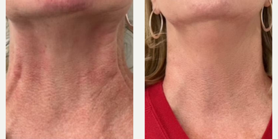 Woman treated with Botox - Woman treated with Botox