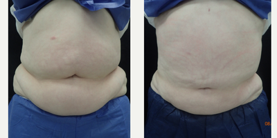 55-64 year old woman treated with Smart Lipo - Smartlipo performed to this 56 year old female's abdomen and waist.