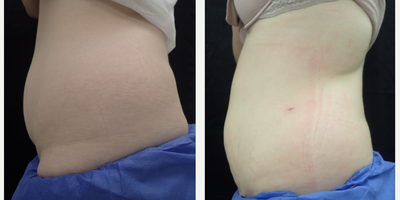 Smartlipo of abdomen and waist - 25 year old female - Smartlipo was performed to this 25 year old female's abdomen and waist