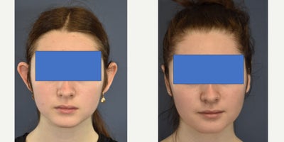 Woman treated with Ear Surgery - Woman treated with Ear Surgery
