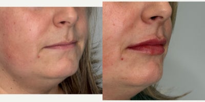 35-44 year old woman treated with Lip Fillers, Revanesse - patient immediately post lip fillers with revanesse lips