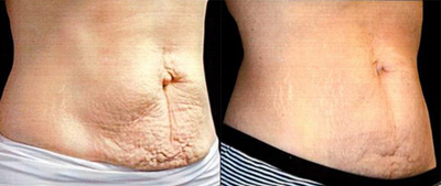 35-44 year old woman treated with Venus Freeze - Venus Freeze is a device used to treat wrinkles, tighten skin, and reduce cellulite and circumferential fat. Using the latest technology, this device delivers Multi-Polar Radio Frequency and Pulsed Magnetic Fields to the skin to produce a dense and uniform heat matrix. This causes collagen production and contraction, fibroblast proliferation, neo-vascularity, and lipolysis, and results in a smoother, firmer skin.