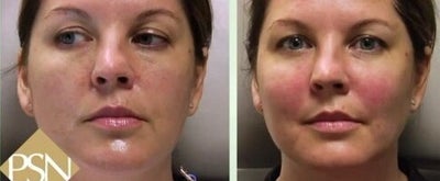 Vampire Facelift - Vampire facelift before and after.
