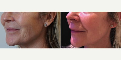Woman treated with ULTRAcel - Woman treated with ULTRAcel