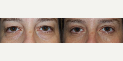 Woman treated with Eyelid Surgery - This patient underwent an Upper and Lower Blepharoplasty, leaving her with an amazing result!