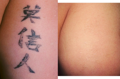 Laser tattoo removal - 
	Before and after laser tattoo removal
