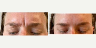 35-44 year old woman treated with Botox for Migraines, Botox, Dysport - Treated by Aubrey H.
