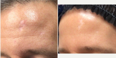 35-44 year old man treated with Subcision - Treating a Forehead Scar with CO2 laser and PRP Subcicion.Patient is also on AZFP Skincare, which has made an amazing improvement in overall face/skin/texture.
