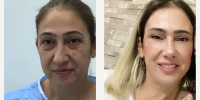 48 year old woman treated with Cheek Augmentation - 48 year old woman treated with Cheek Augmentation throughFacial Fat Transferas well as Deep Plane Facelift,Rhinoplasty, Eyelid Surgery, andNeck Lift, shown 1 year post op. Pre-op, patient felt older than her real age. She got back her confidence after having the procedures.