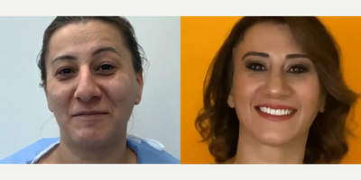 36 year old woman treated with Cheek Augmentation - 36 year old woman treated with Cheek Augmentation through facial fat transfer (lips and around the eyes) as well as Deep Plane Facelift, Rhinoplasty,Eyelid Surgeryand Neck Lift,, shown 10 months post op.