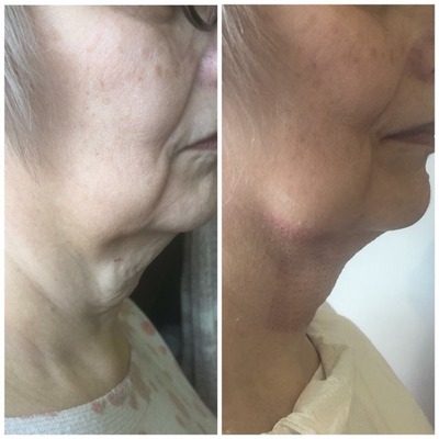 55-64 year old woman treated with Laser Treatment - Plasma Fibroblast (PlasmaLift) Neck Lift