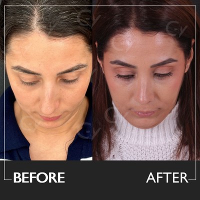 25-34 year old woman treated with Rhinoplasty - Rhinoplasty