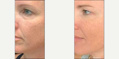 Woman treated with Secret RF - Woman treated with Secret RF.