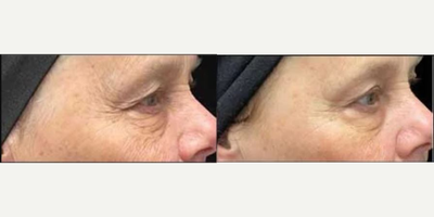 Woman treated with Secret RF - Woman treated with Secret RF.