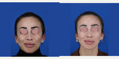 25-34 year old woman treated with Skin Lightening - Melasma Treatment Using Medical Grade Skin Care Regimen - Results After Just Six Weeks of Using Topicals