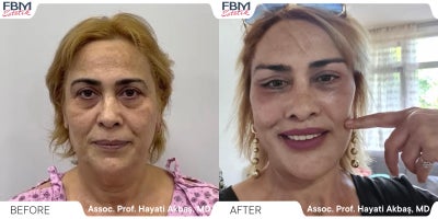 35-44 year old woman treated with Deep Plane Facelift, Eyelid Surgery, Facial Fat Transfer, Lip Lift - 35-44 year old woman treated with Deep Plane Facelift, Eyelid Surgery, Facial Fat Transfer, Lip Lift
