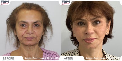 55-64 year old woman treated with Deep Plane Facelift, Neck Lift, Double Eyelid Surgery, Facial Fat Transfer, Rhinoplasty - 55-64 year old woman treated with Deep Plane Facelift, Neck Lift, Double Eyelid Surgery, Facial Fat Transfer, Rhinoplasty