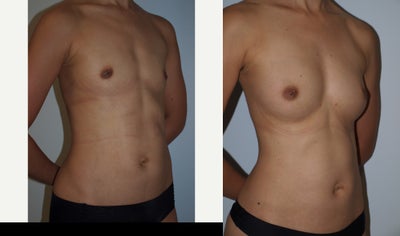 35-44 year old woman treated with Breast Fat Transfer (4 Months Post- Op) - 37yo female with loss of breast volume following pregnancy who desired all natural breast enlargement as well as body contouring for excess fat of her muffin tops, buttocks and outer hips. Results are 4&nbsp;months following liposuction and transfer of 350cc into each breast.