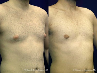 Male Breast Reduction - 18-24 year old man treated with Male Breast Reduction
