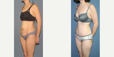 25-34 year old woman treated with Tummy Tuck - Full tummy tuck muscle repair
