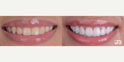 Woman treated with Porcelain Veneers, Smile Makeover - Woman treated with Porcelain Veneers, Smile Makeover