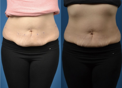 35-44 year old woman treated with SculpSure - SculpSure patient with treatment to abs and flanks